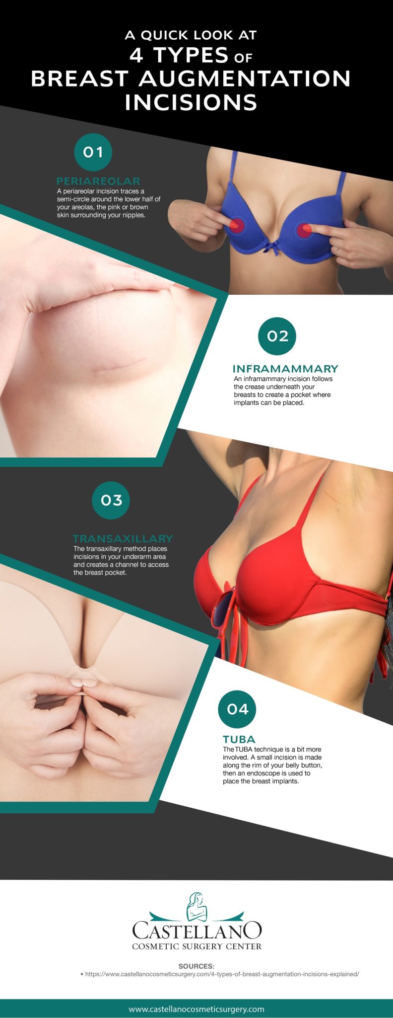 Different Breast Augmentation for Different Body Types
