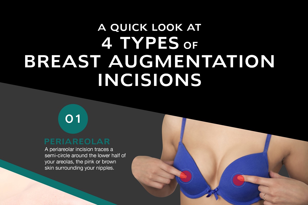 A Quick Look at 4 Types of Breast Augmentation Incisions [Infographic]