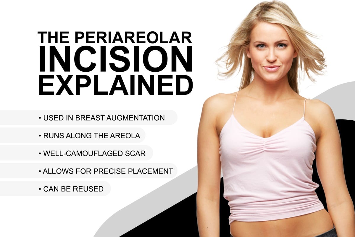 The Periaerolar Incision Explained [Infographic]
