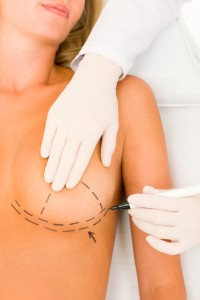 4 Options for Breast Augmentation Incision Placement img 1